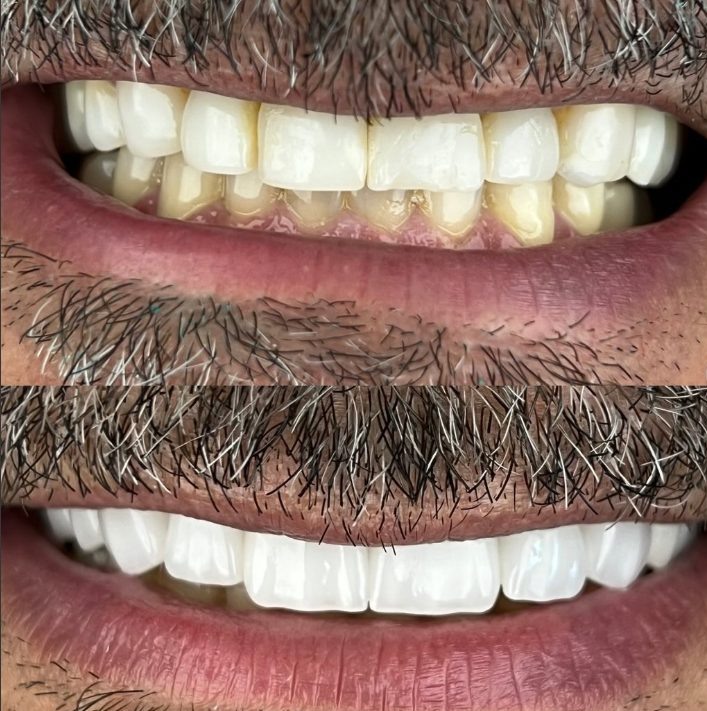 Antes e depois de clareamento dental feito pelo Dr. Rafael Melo