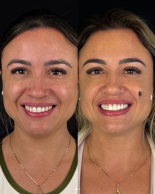 Antes e depois de tratamento com lentes de contato dental — paciente do Dr. Rafael Melo